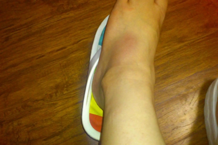 踝扭伤脚踝轻微肿胀发红图