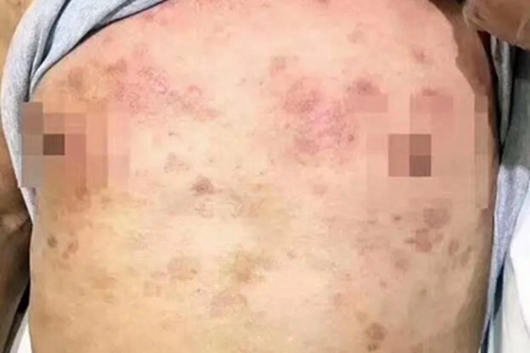 疱疹样天疱疮胸部皮肤颜色加深图