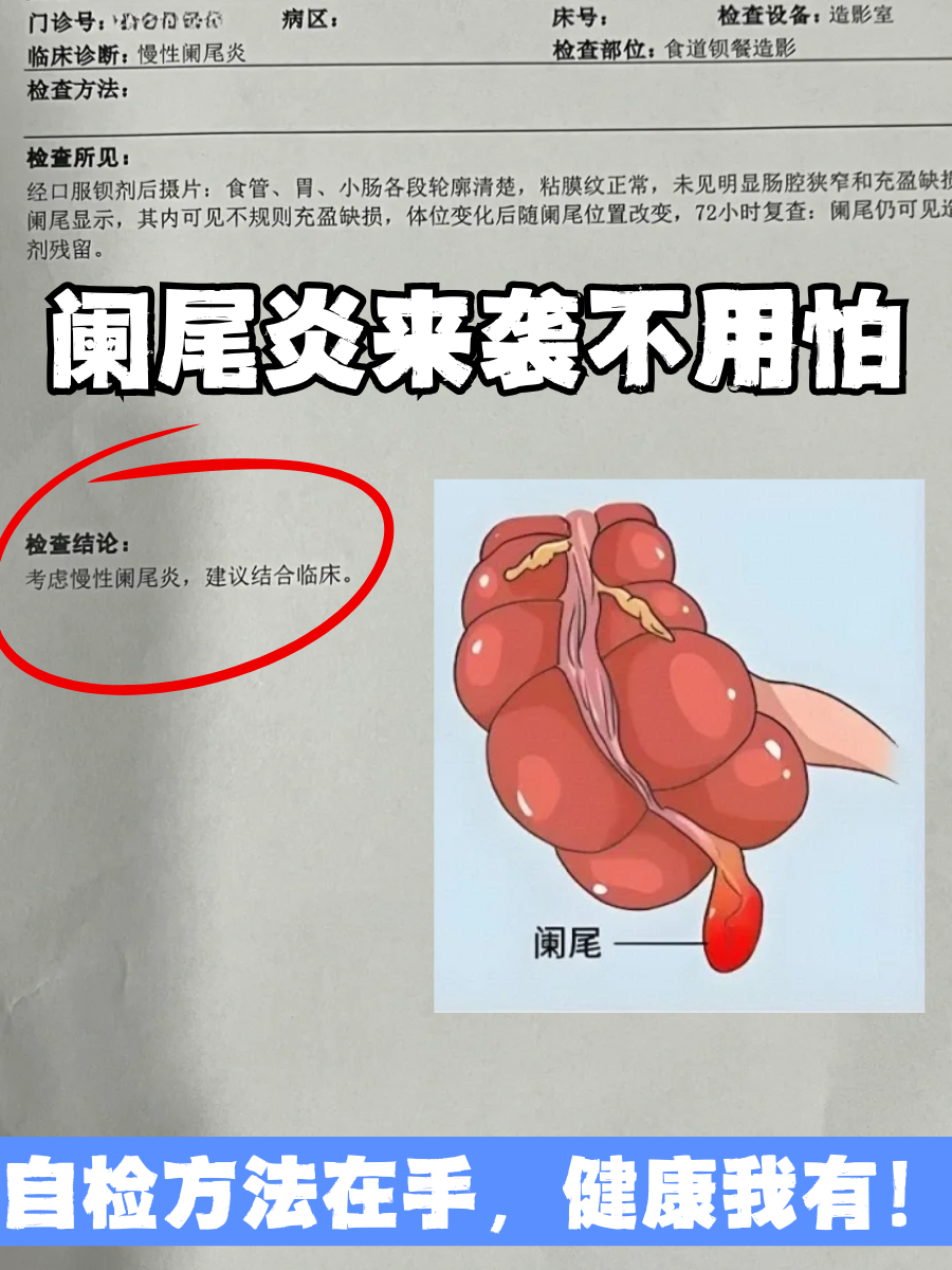 阑尾炎来袭不用怕，自检方法在手，健康我有！