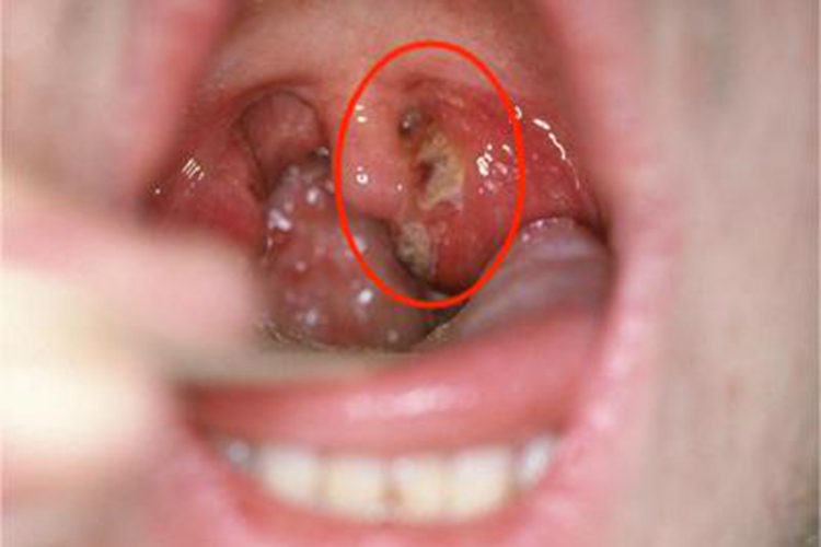 急性咽炎黄白色渗出物图 急性咽炎黄白色渗出物图