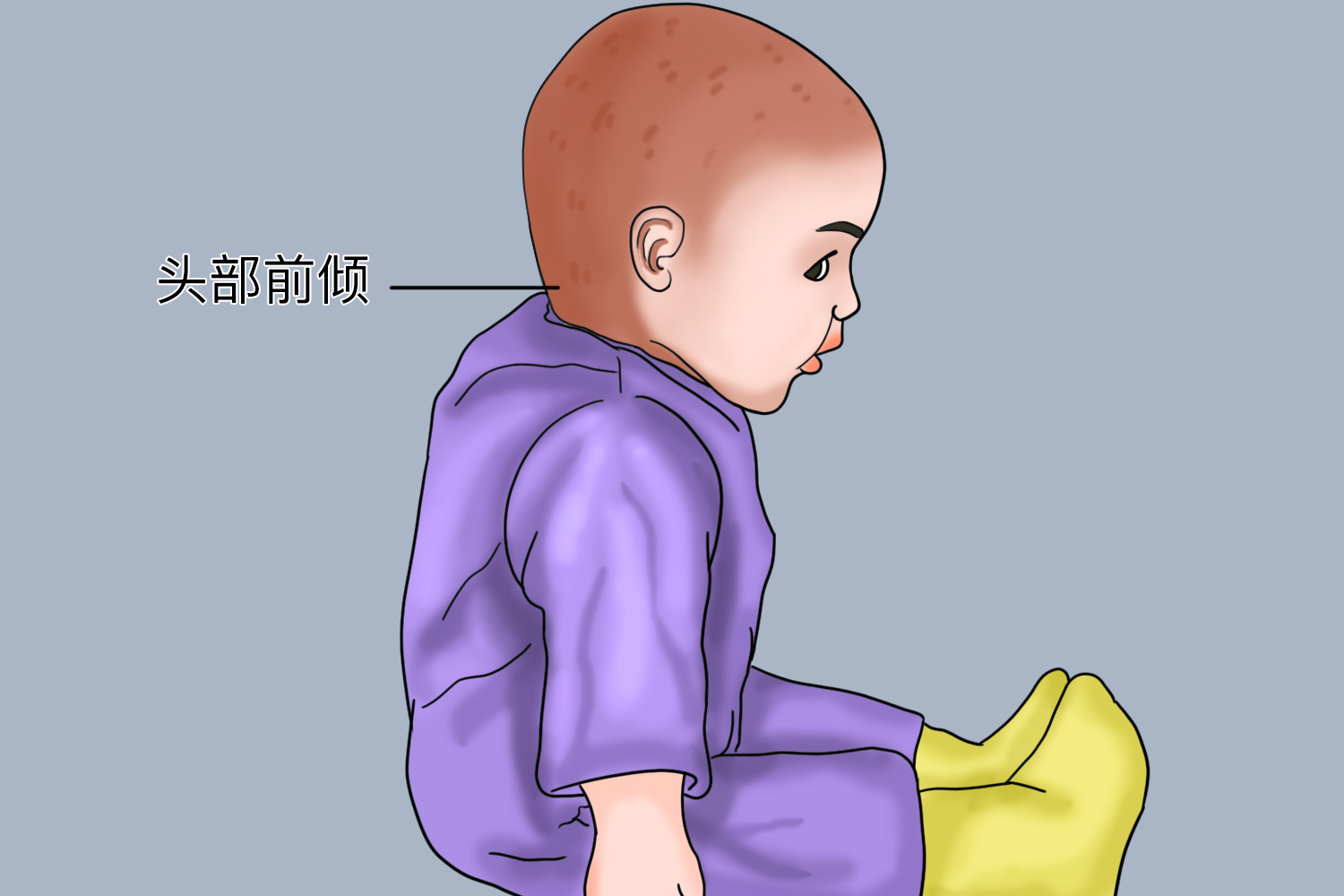 3个半月婴儿头前倾图