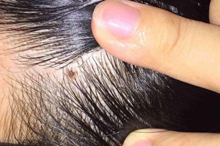 毛结节菌病头发症状图