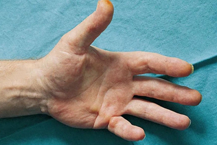 掌腱膜挛缩症手部僵硬图 掌腱膜挛缩症手部僵硬图