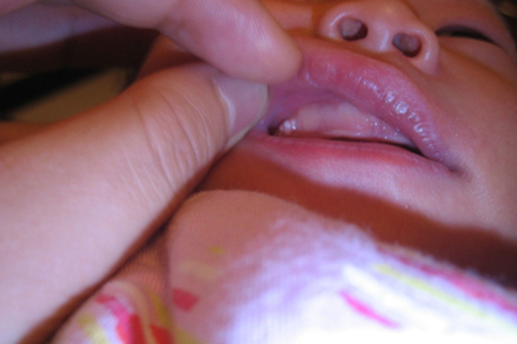 上皮珠图 上皮珠图