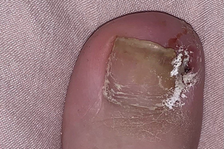 慢性甲沟炎脚趾化脓图 慢性甲沟炎脚趾化脓图