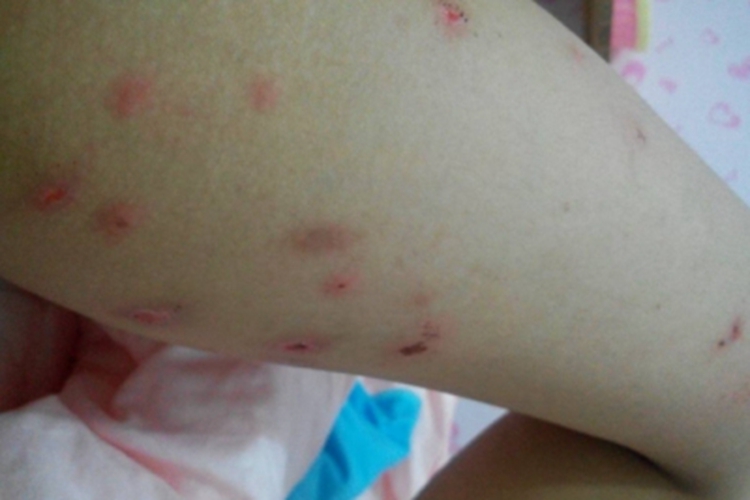 虫咬皮炎血痂图