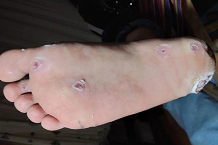 寻常疣脚底多处糜烂脱皮图