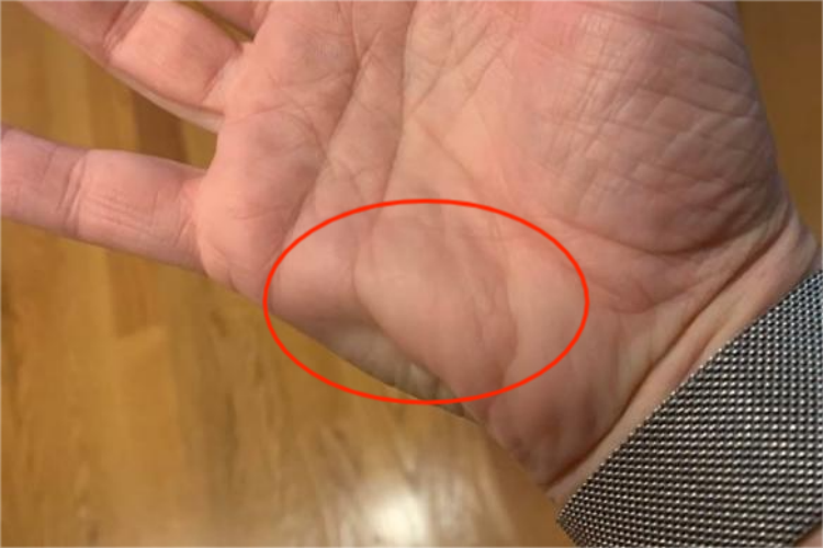 手肌肉痉挛图 手肌肉痉挛图