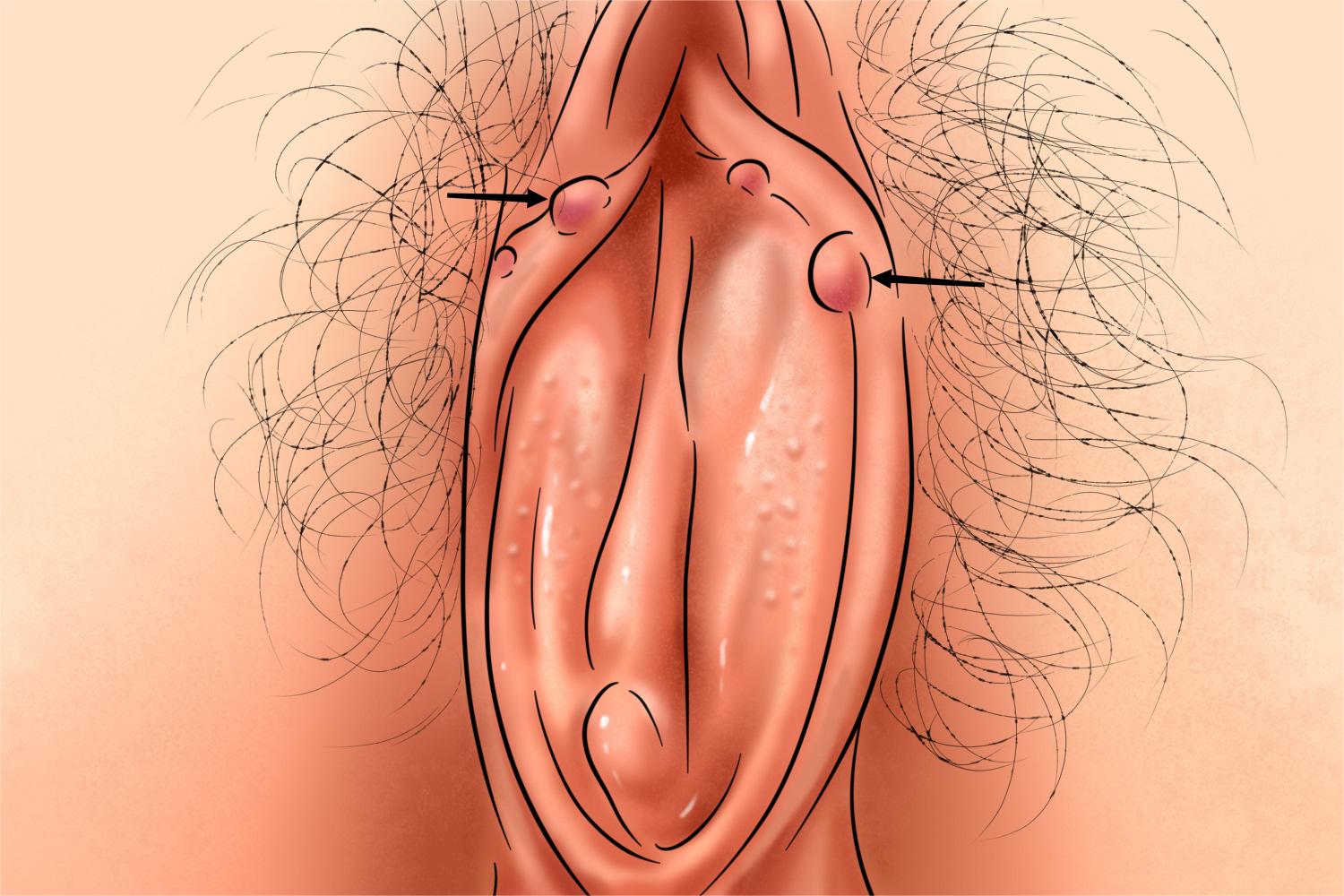 假性湿疣图 假性湿疣图