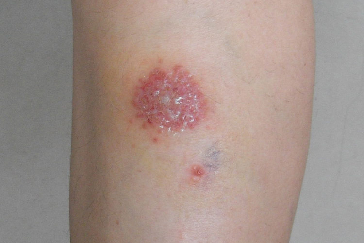 小腿慢性湿疹图片