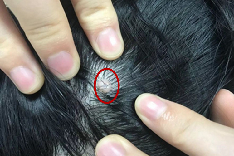 毛囊痣头皮症状图