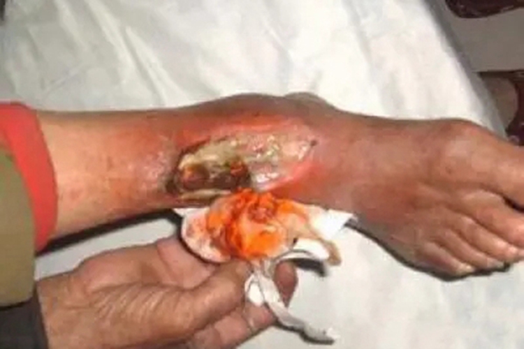 结节性血管炎脚踝溃疡图