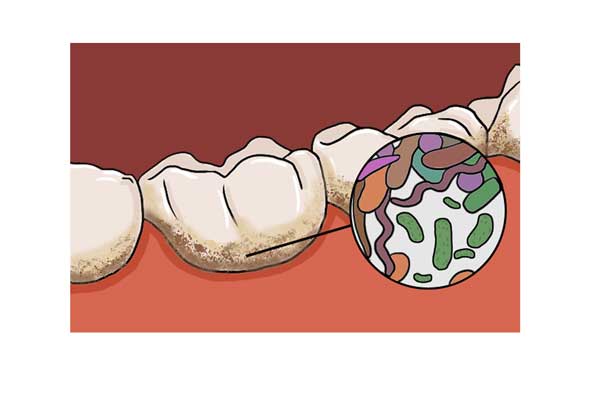 一旦某些类型的细菌在牙齿上滋生,就会在口腔中形成牙菌斑,需要由