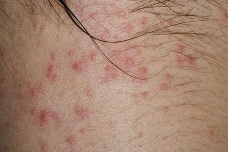 过敏致接触性皮炎图 过敏致接触性皮炎图