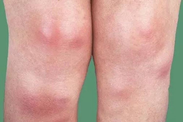 结节性红斑膝盖症状图