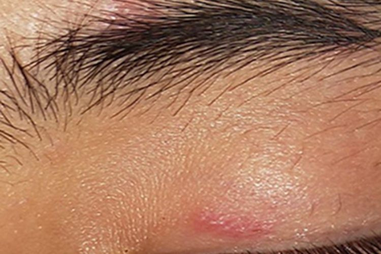 急性眼睑湿疹眼睑丘疹图