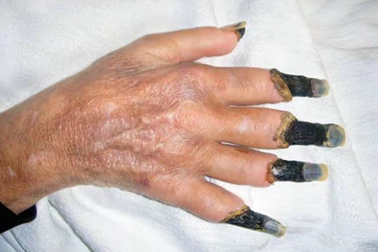 干性坏疽症状图