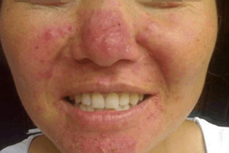 丘疹脓疱型酒糟鼻鼻部红斑图