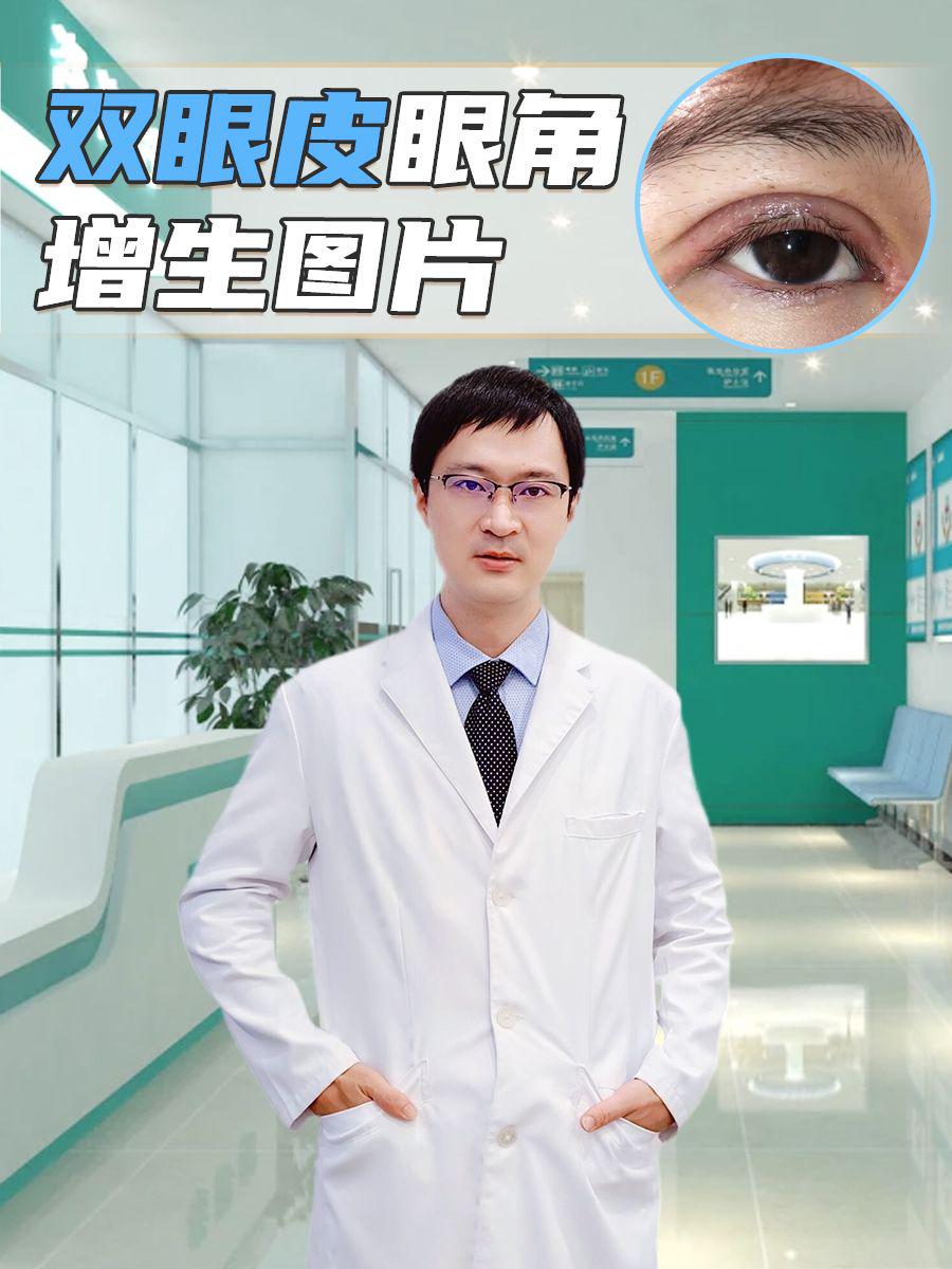 双眼皮眼角增生图片