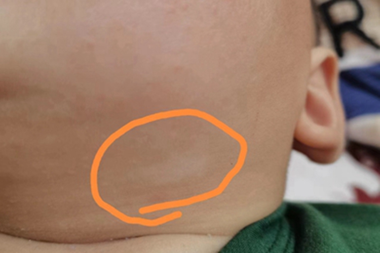 无色素痣颈部皮肤变白图 无色素痣颈部皮肤变白图