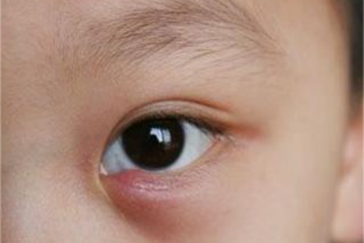 急性泪囊炎眼睑红肿图