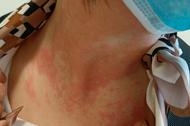 太藤丘疹红皮病丘疹症状图