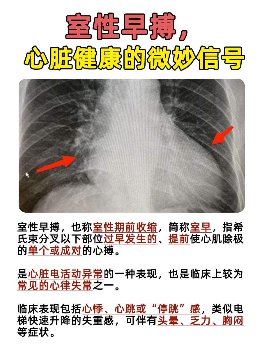 室性早搏，心脏的小插曲你懂吗？