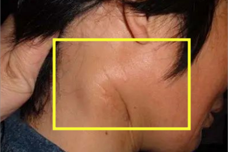 流行性腮腺炎颈部肿图