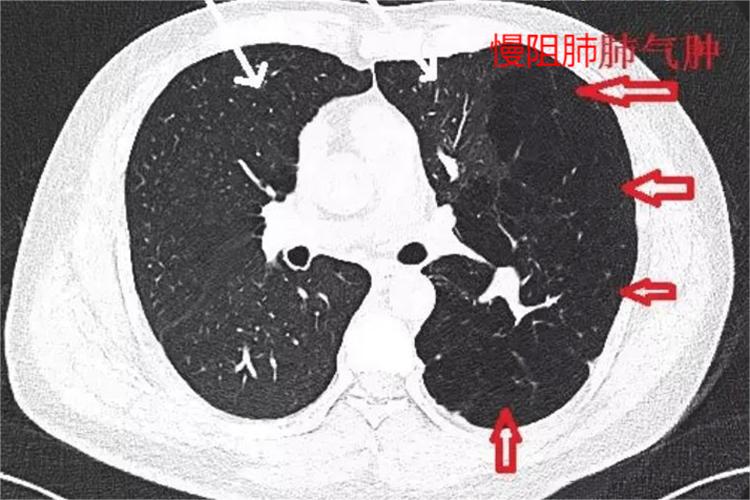 慢阻肺肺气肿CT图