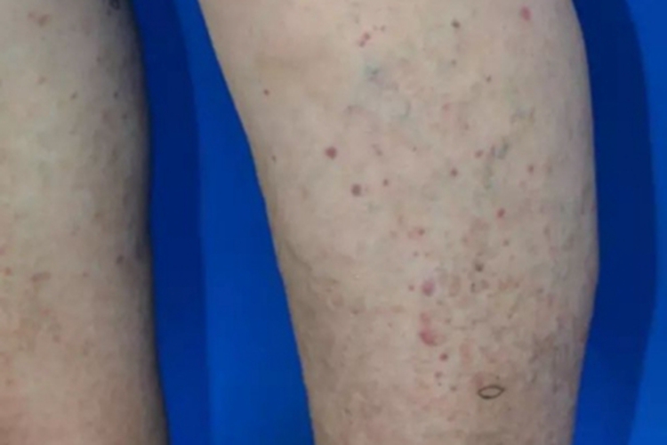 异常蛋白血症紫癜小腿紫斑图