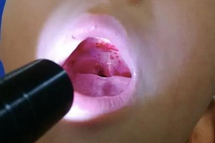 血小板低嘴巴密集血疱图