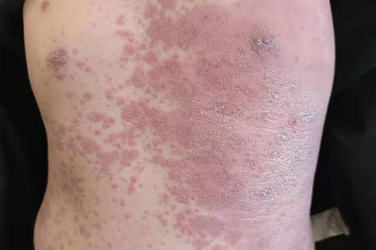 躯干药疹红疹图