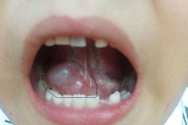 正常人的舌下腺图片图片