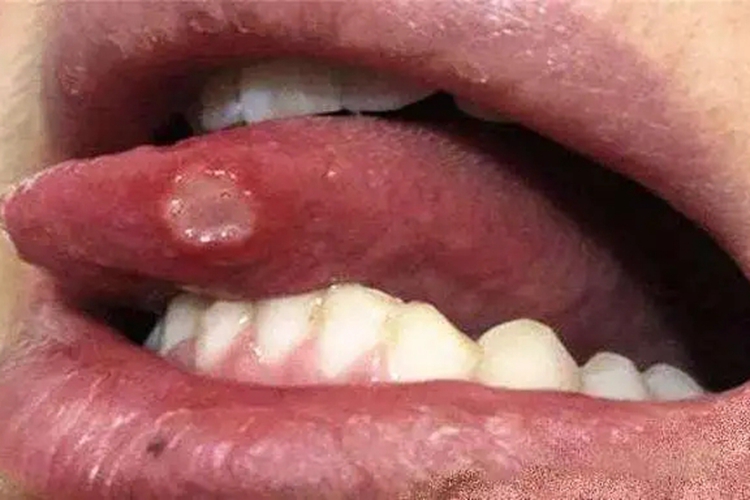 重型复发性阿弗他溃疡图 重型复发性阿弗他溃疡图