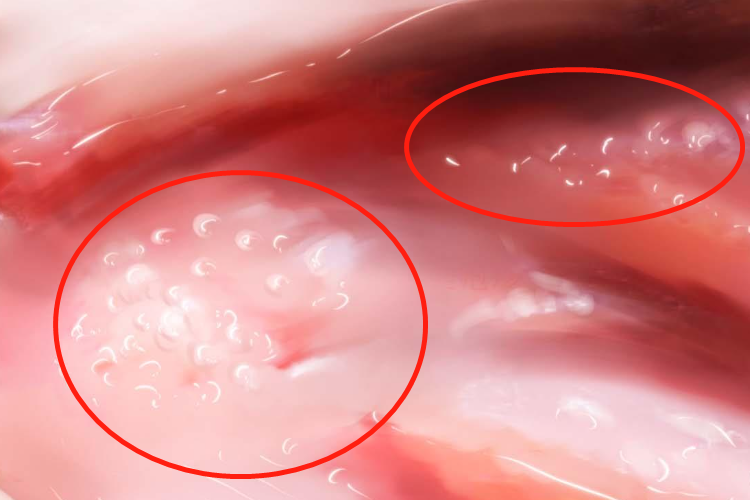 生殖器疱疹女性会阴部丘疹图 生殖器疱疹女性会阴部丘疹图
