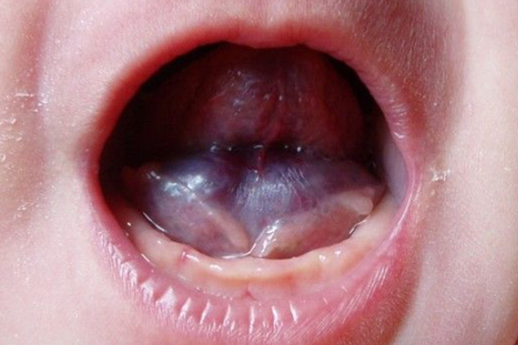 刚出生的婴儿舌下腺囊肿图 刚出生的婴儿舌下腺囊肿图