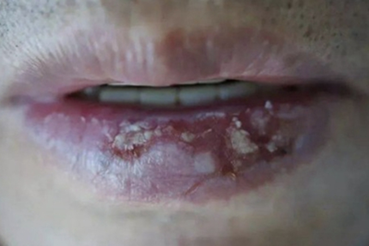 念珠菌性唇炎症状图