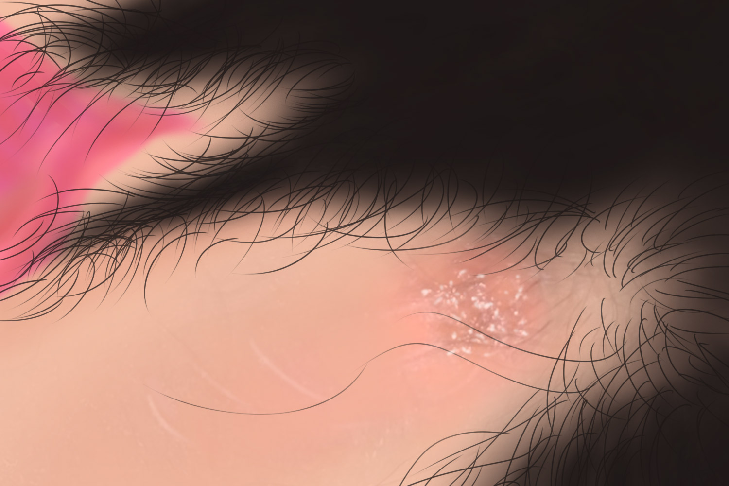 女性初发性生殖器疱疹图