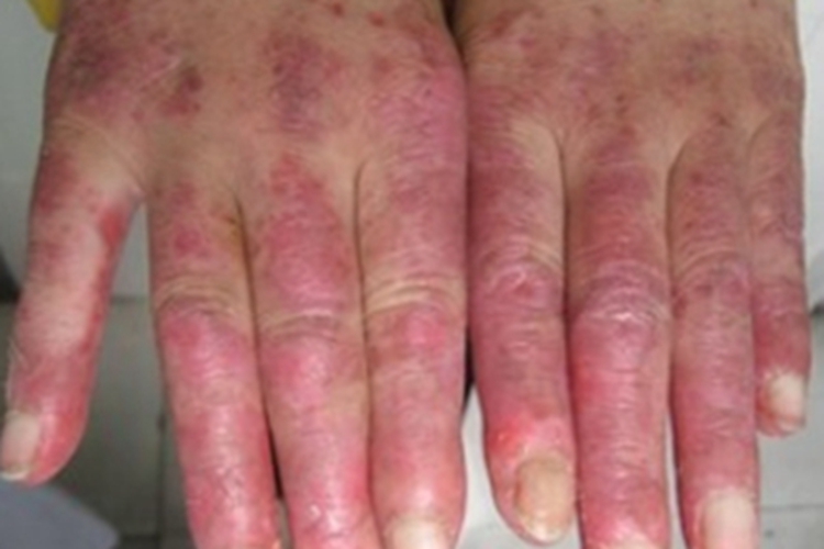 急性放射性皮炎手背红斑图