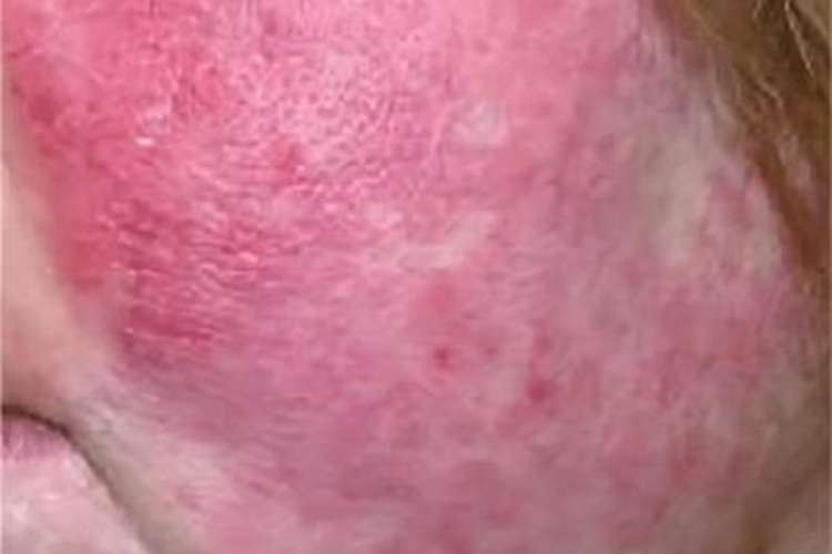 急性皮肤型红斑狼疮水肿性红斑图