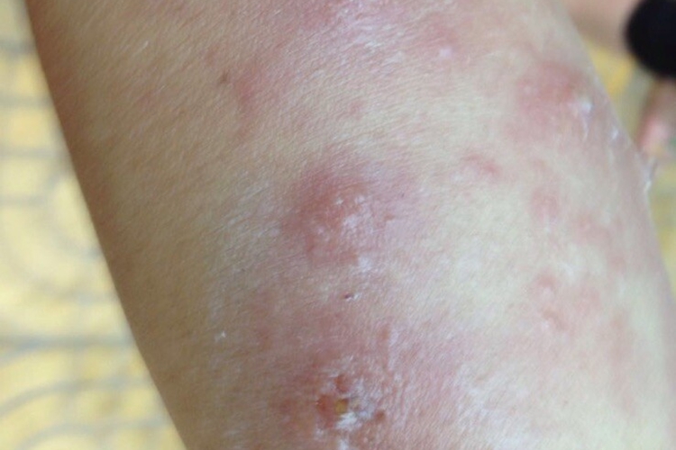 被白蚁咬了症状图