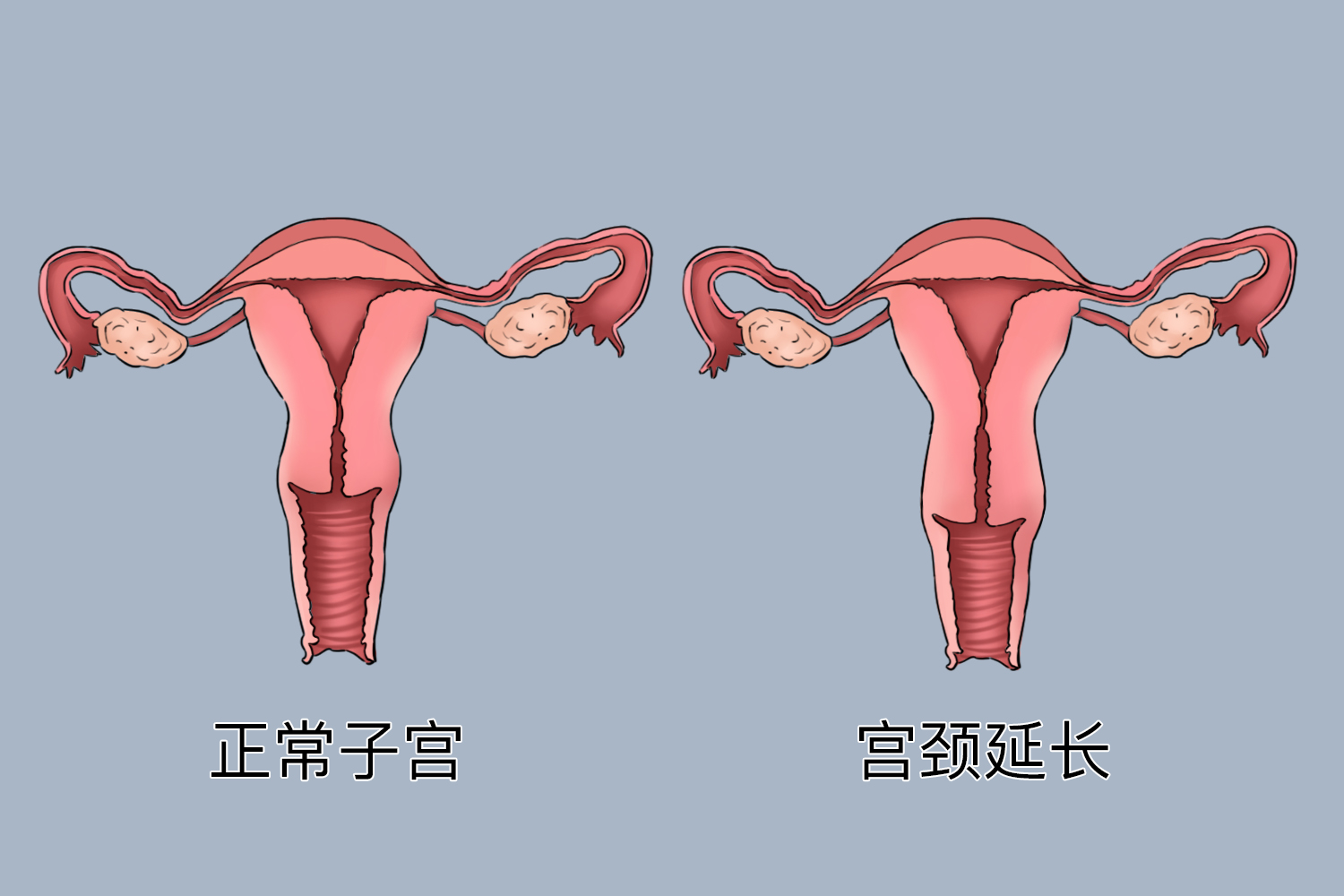 宫颈内口松弛图片图片