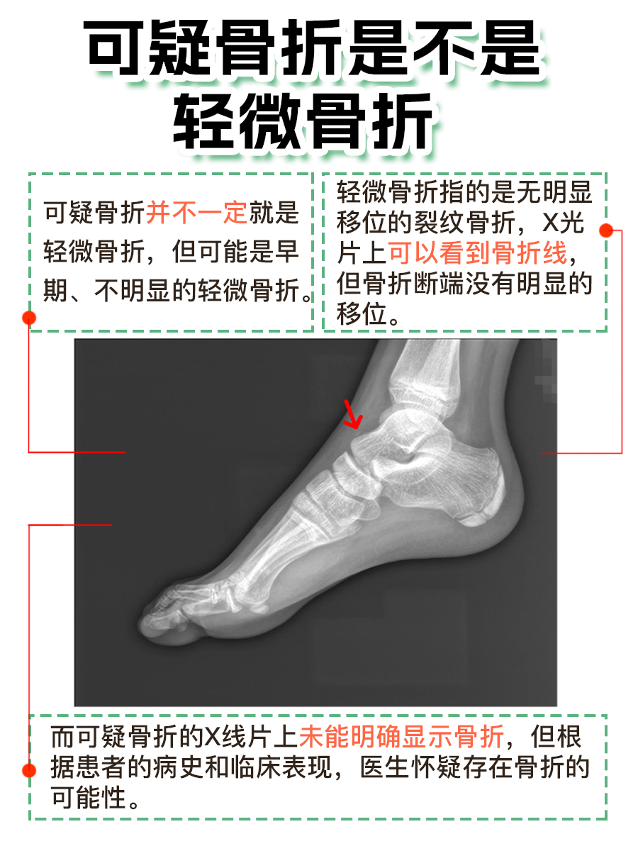 注意！可疑骨折迹象初现，是轻微还是严重？