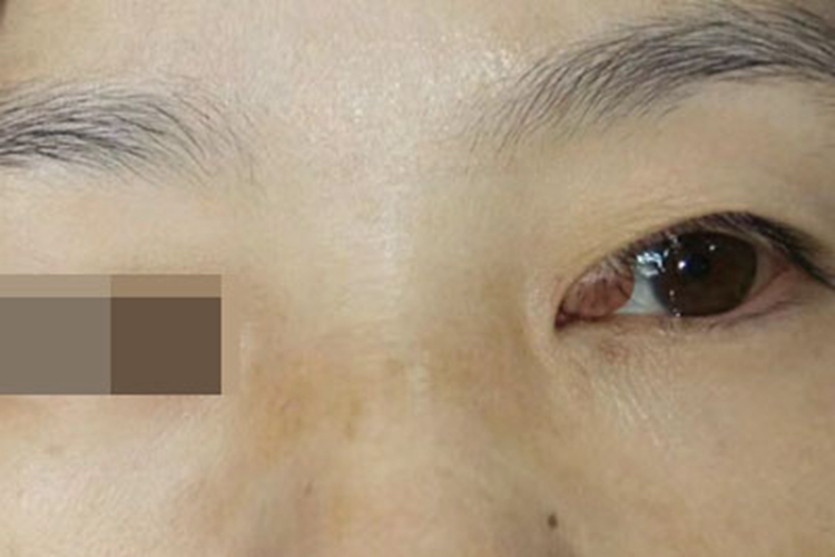 皮内痣眼角处有一颗痣图