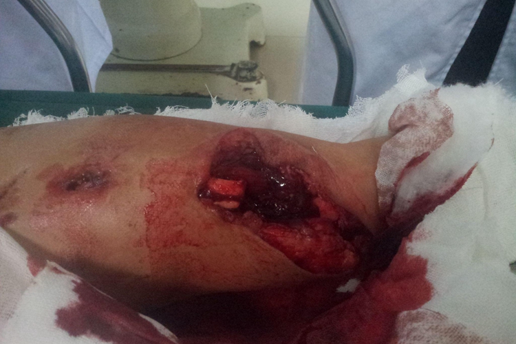 女生腿摔伤流血图 女生腿摔伤流血图