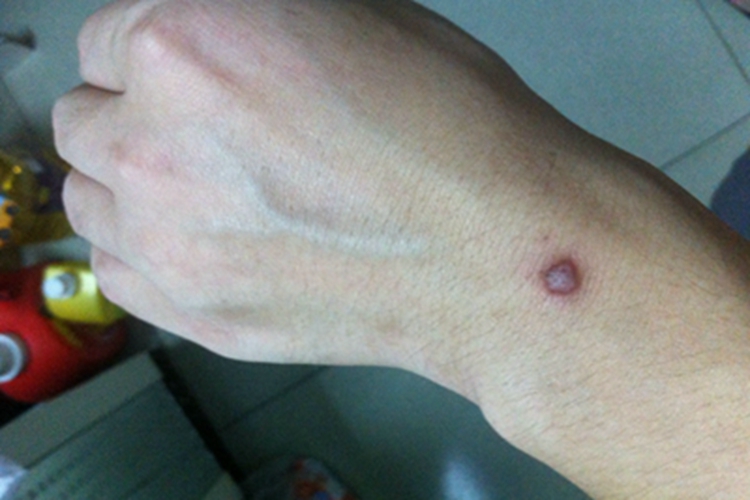 扁平疣样职业性疣赘手腕症状图