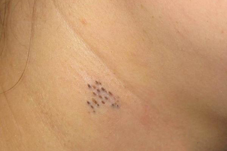 脖子黑头粉刺痣图