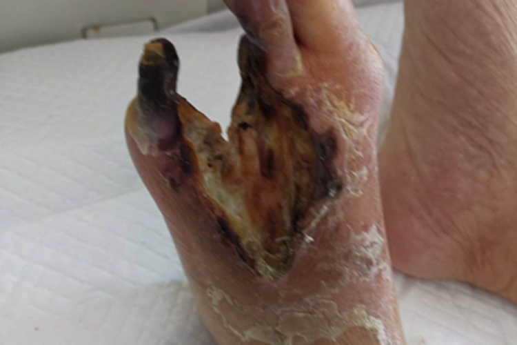 干性坏疽缺损图 干性坏疽缺损图