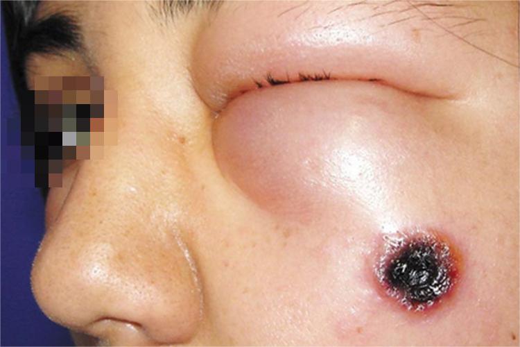 炭疽病眼周水肿图