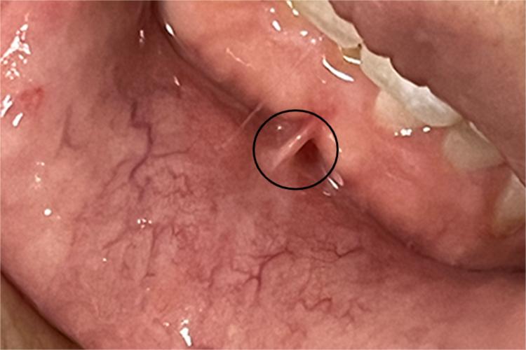 正常下唇系带图